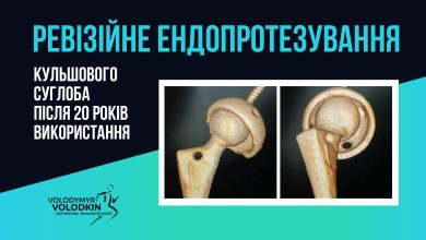 Ревізійне ендопротезування кульшового суглоба після 20 років експлуатації