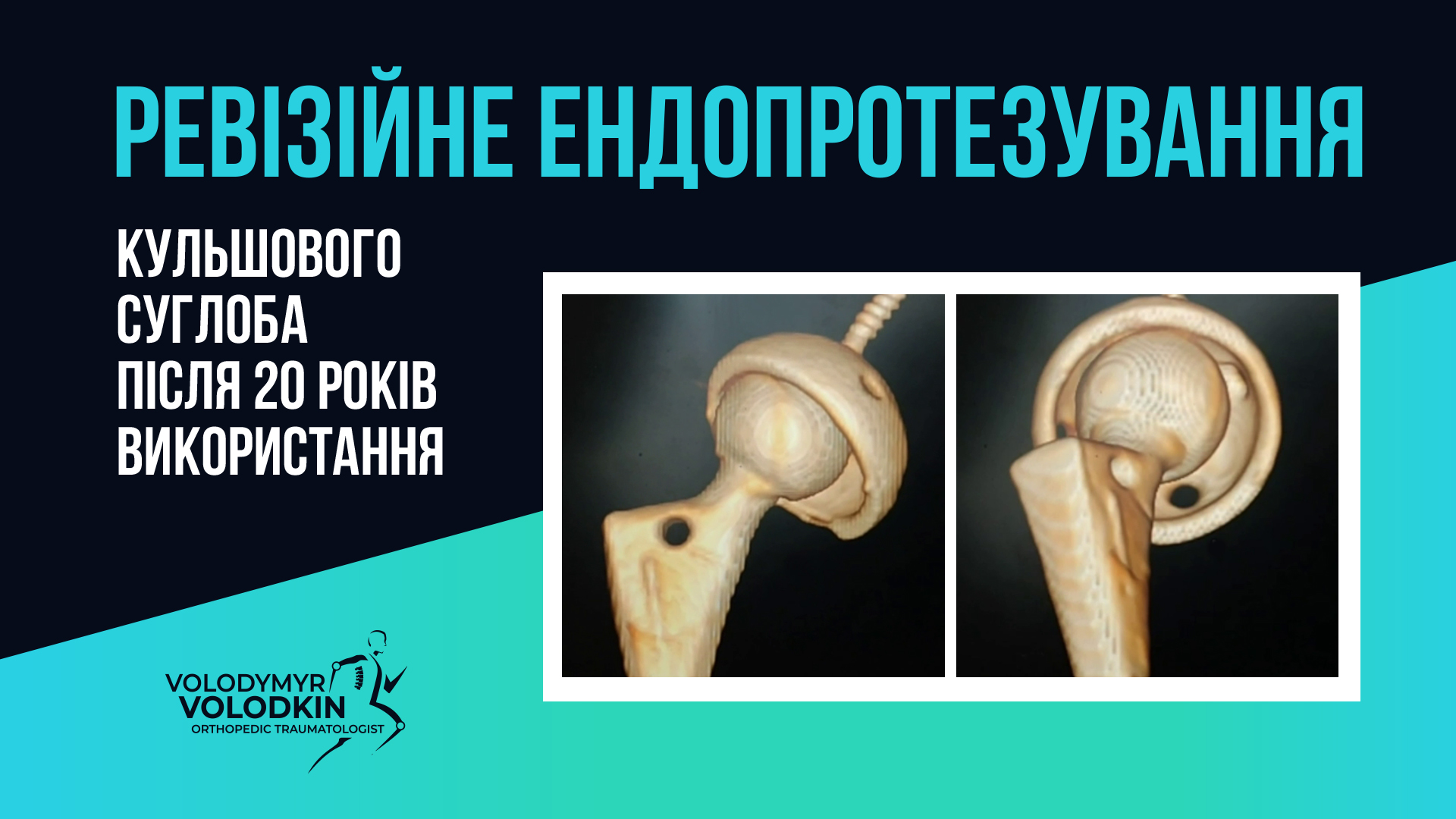 Reviziine_endoprotezuvannya,ревізійне_ендопротезування,ревизионное_эндопротезирование,эндопротезированиекиев