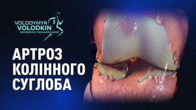 Артроз колінного суглоба